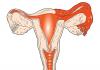 सल्पिंगिटिस क्या है: स्त्री रोग संबंधी सूजन, ओओफोराइटिस के लक्षण और उपचार